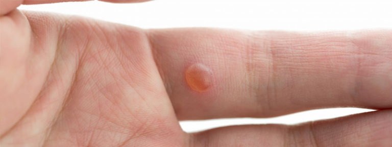 Tratamento de Verrugas Antes e Depois - Clinica Bergmann