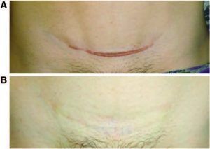 Cicatriz hipertrófica cesárea antes e depois