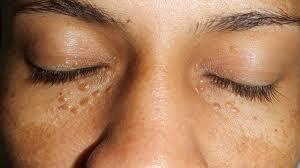 cirurgia-estetetica-cirurgia-geral-siringoma-em-porto-alegre-01