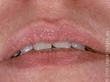 cirurgia-estetica-cirurgia-geral-granulos-de-fordyce-em-porto-alegre-02