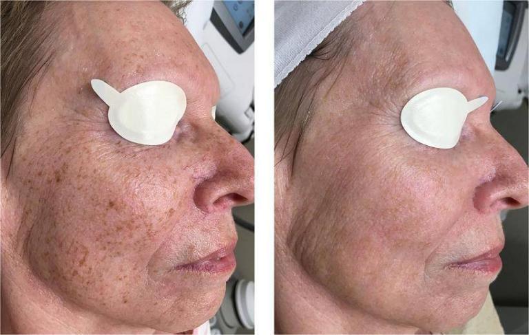 Tratamento a LASER de Mancha das Mãos, Lentigo e Manchas Senis