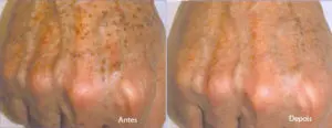 Antes e depois Tratamento mancha nas mãos
