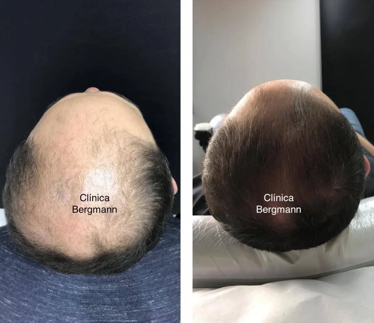 Dermatologista Especialista em Queda de Cabelo