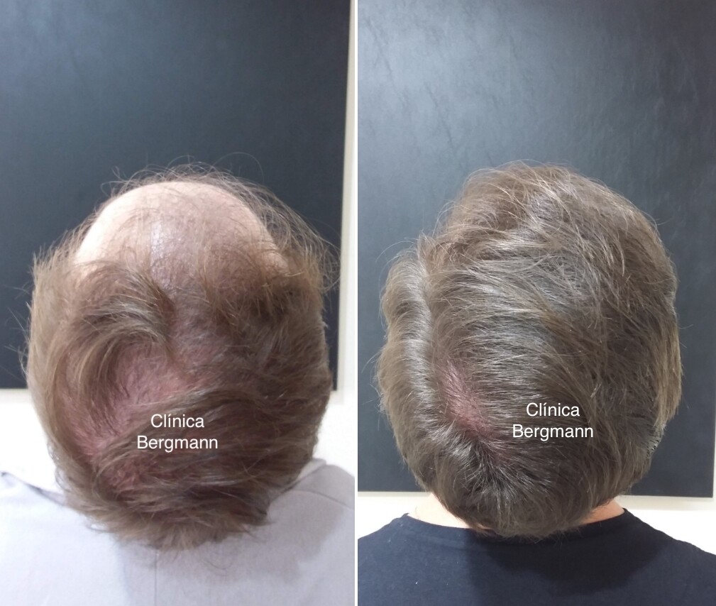 Tratamento capilar após queda de cabelo por covid