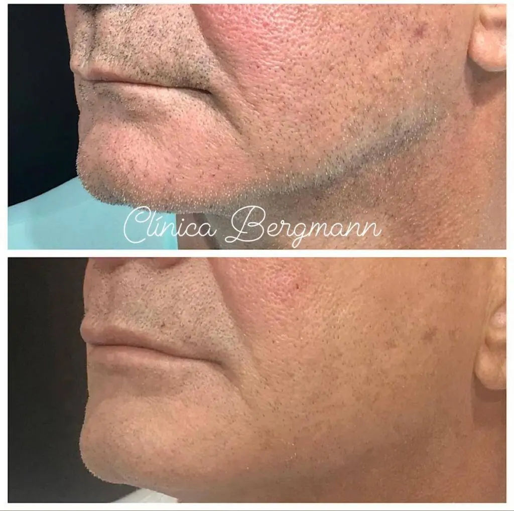 Labios homem maduro antes e depois