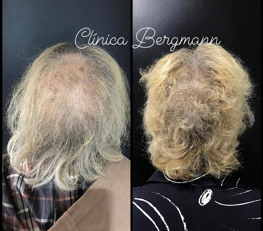 Antes e Depois tratamento capilar alopecia androgenética