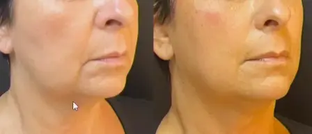 Bigode chinês + linha de marionete antes e depois Fio temporal antes e depois