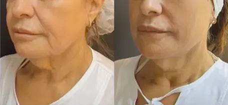 Bigode chines + linha marionete antes e depois Antes e depois Fios temporais