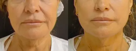 Bigode chinês + linha marionete antes e depois Fio Temporal antes e depois