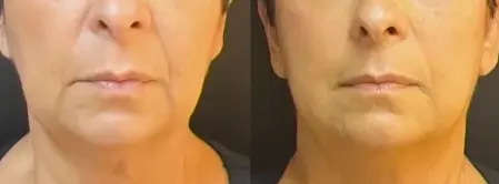 Bigode chinês linha marionete antes e depois Antes e depois fio temporal