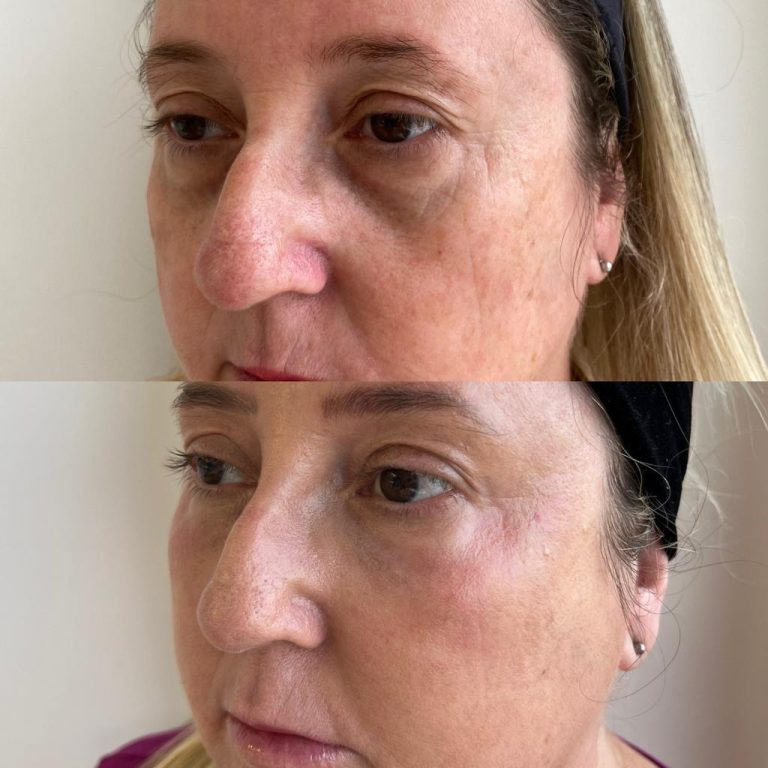 Line Skin Peeling de Fenol com Máscara Clínica Bergmann