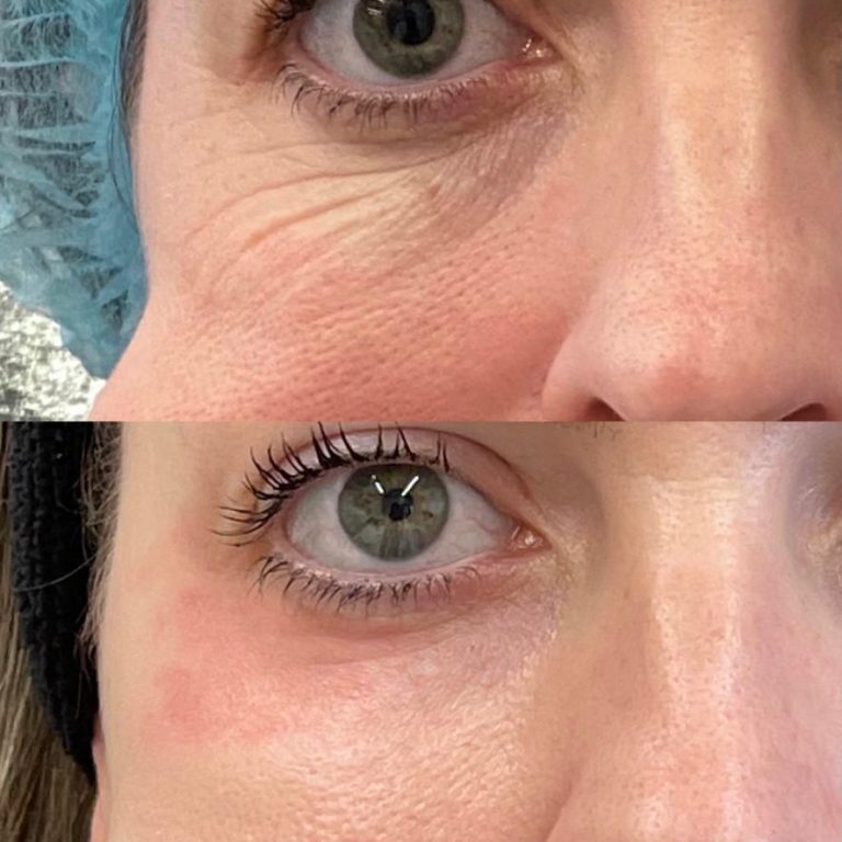 Line Skin Peeling de Fenol com Máscara Clínica Bergmann