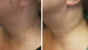 acrocordon antes depois