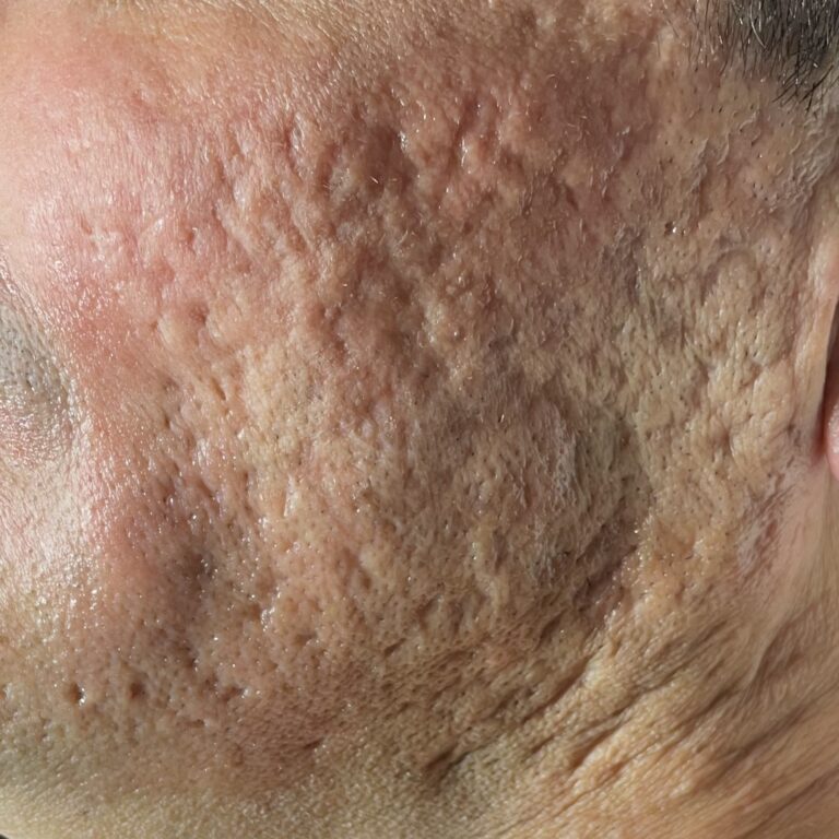 Cicatrizes de Acne