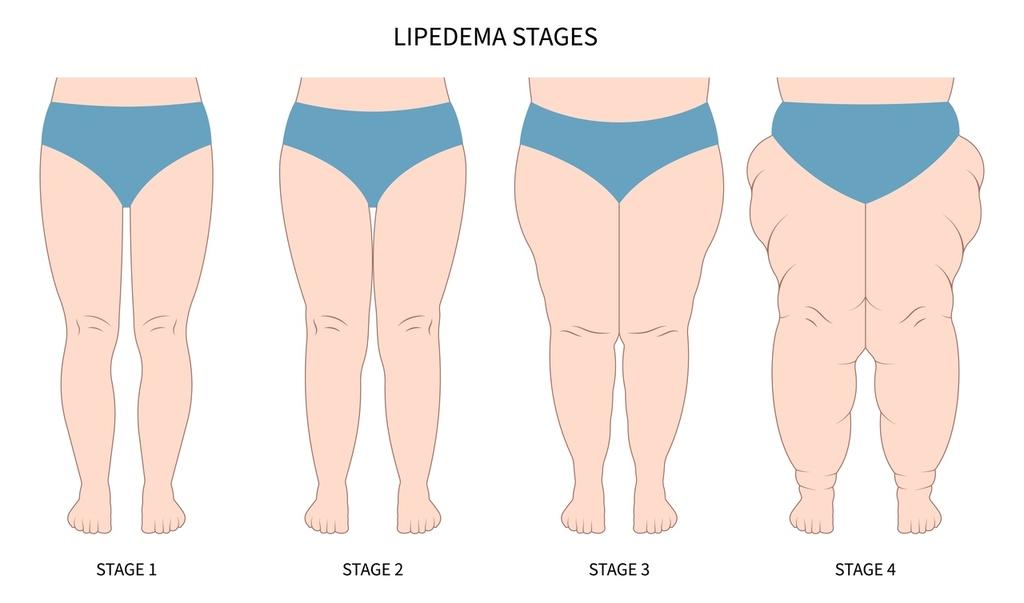 estagios-do-lipedema-1709160050