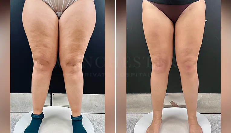 lipedema antes depois